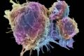 Combattere il cancro "affamando" le cellule tumorali