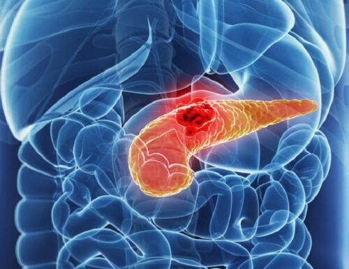 Tumore del pancreas: primo successo dell’immunoterapia